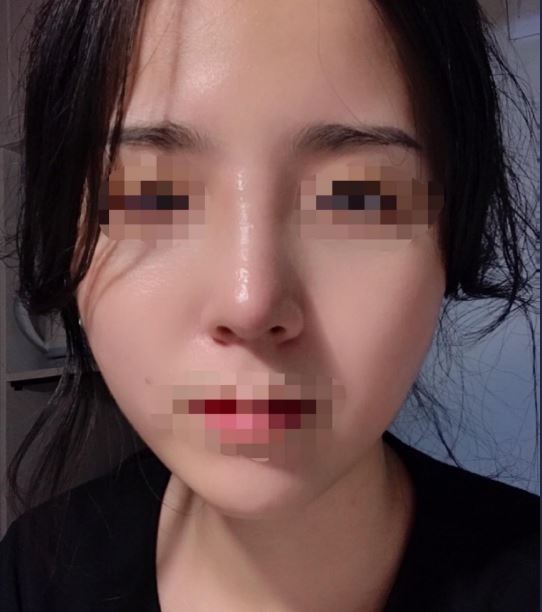 2주차 수술후기