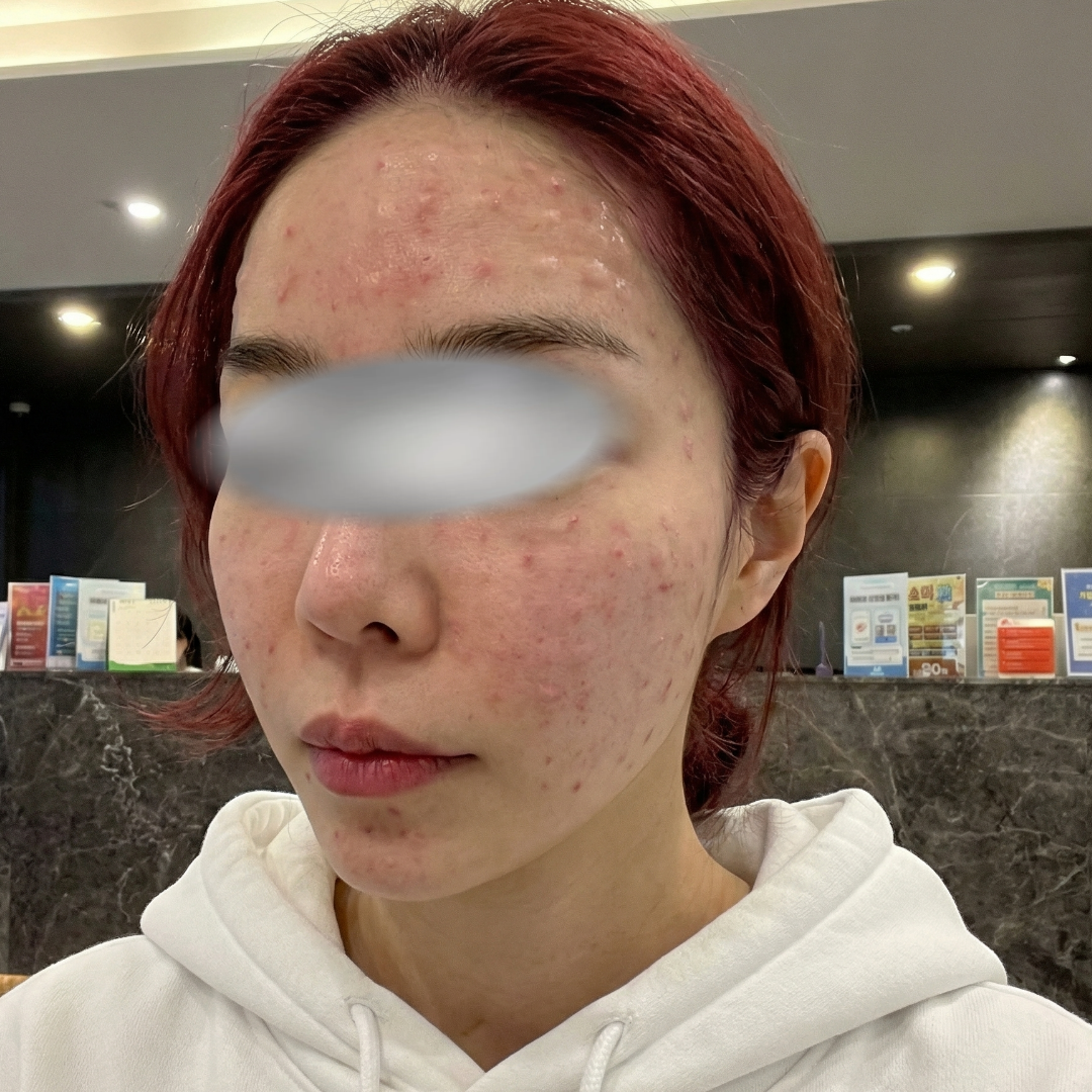 리쥬란 4cc 수면으로 하고 방금 집 옴