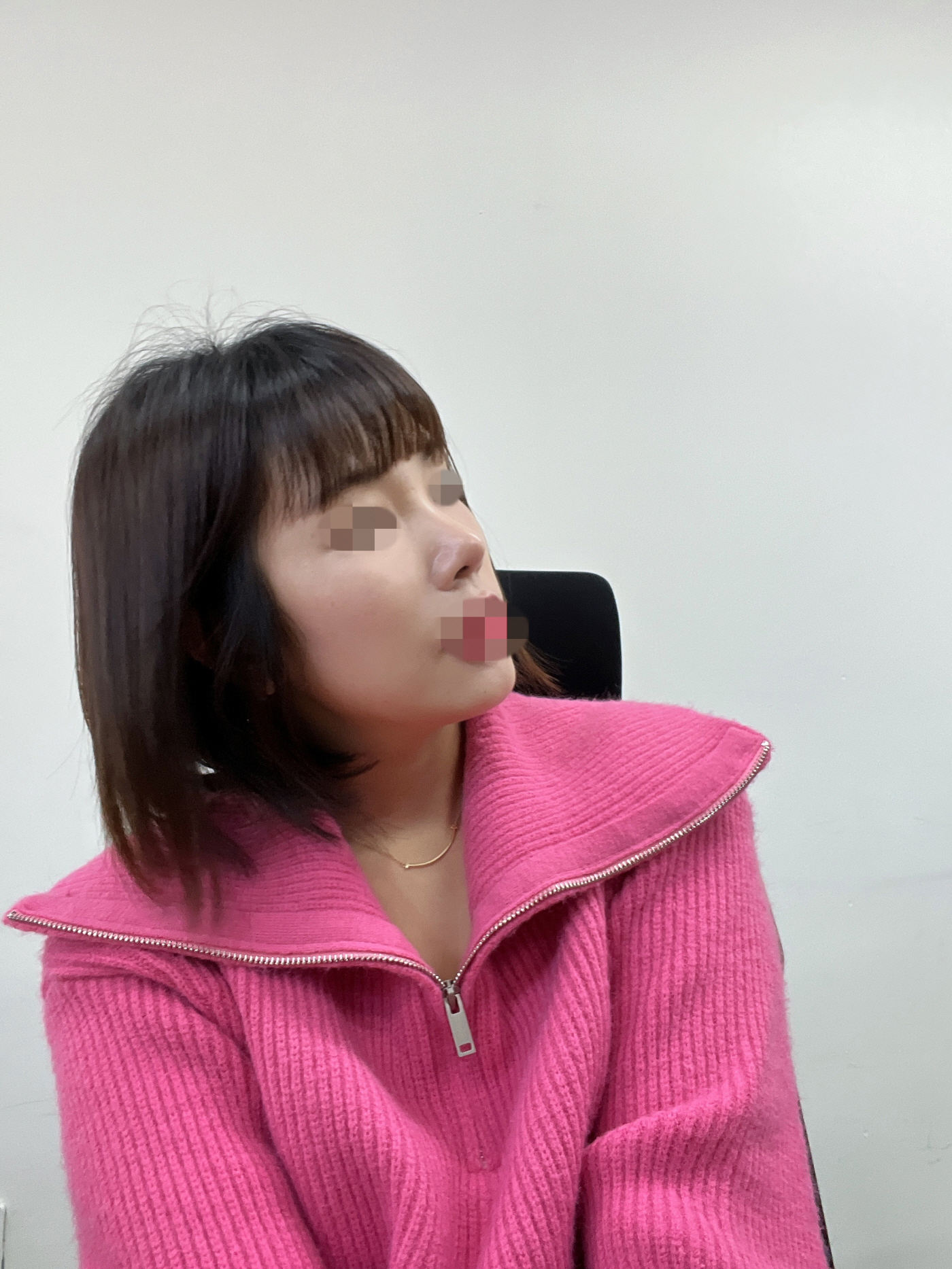 붓기도 거의 가라앉아 굉장히 자연스러워졌어요.