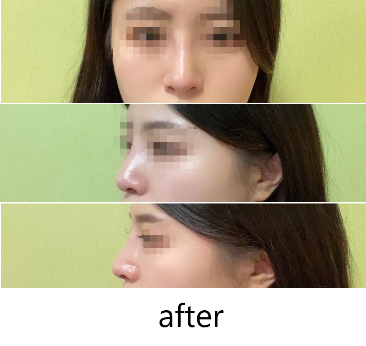 휜코 화살코 수술 받았습니다앙