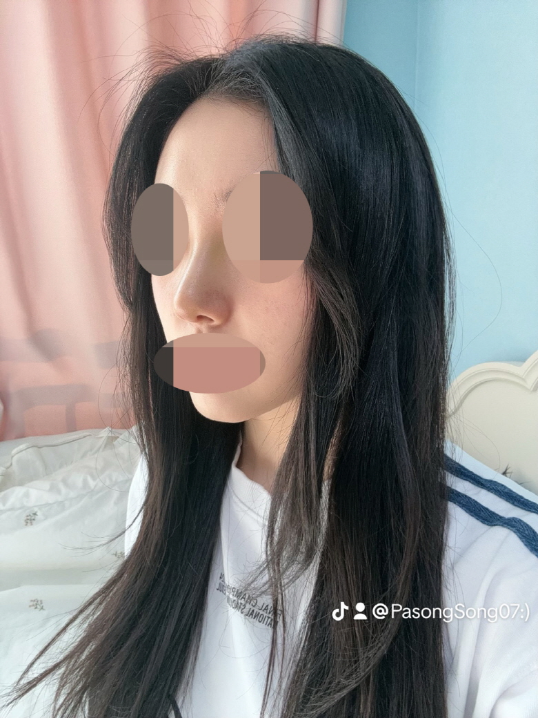 자연스럽게 코끝만 올려달라고 했는데 잘 해주셔서 만족스러워용 :)
