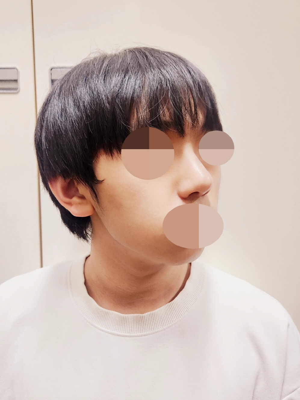 붓기도 잘 가라앉고있고 휜코 교정이 잘되어서 기분이 좋아요!!