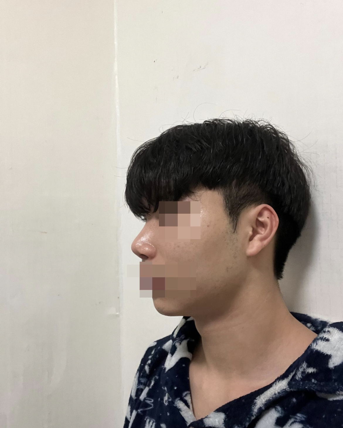 원장님께 감사하는중입니다 서울아이성형외과 추천드려요~~