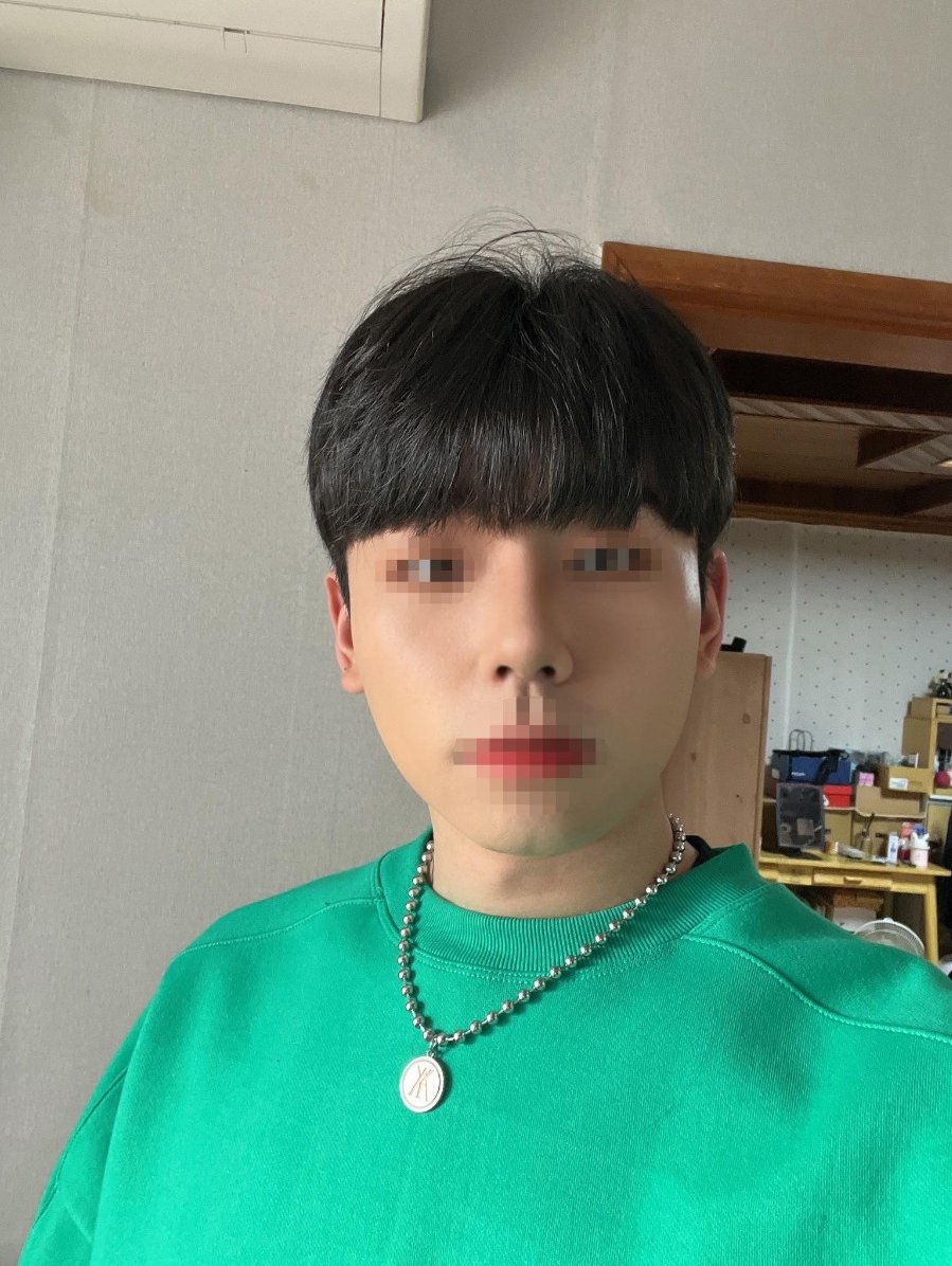 코수술 후기