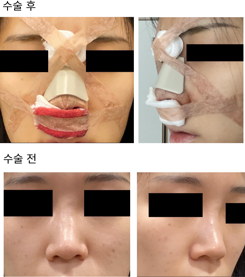 코 수술 1일차 후기