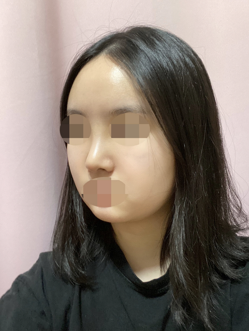 코 모양이 제가 원하던 대로 자연스럽게 된 것 같아서 매우 만족합니다!!