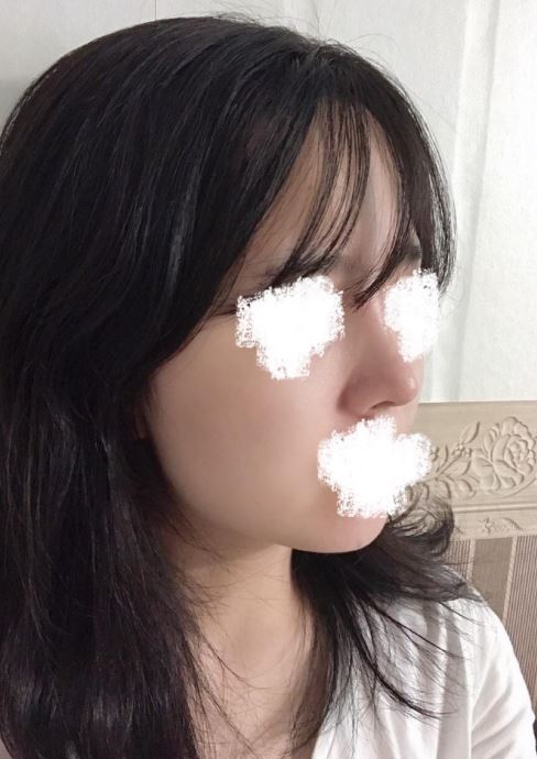 코수술 한달차 후기요!