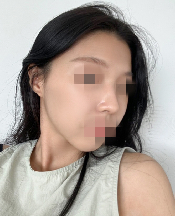 이 코를 만 들어주신 황정일 원장님 진심으로 감사합니다~~!~!