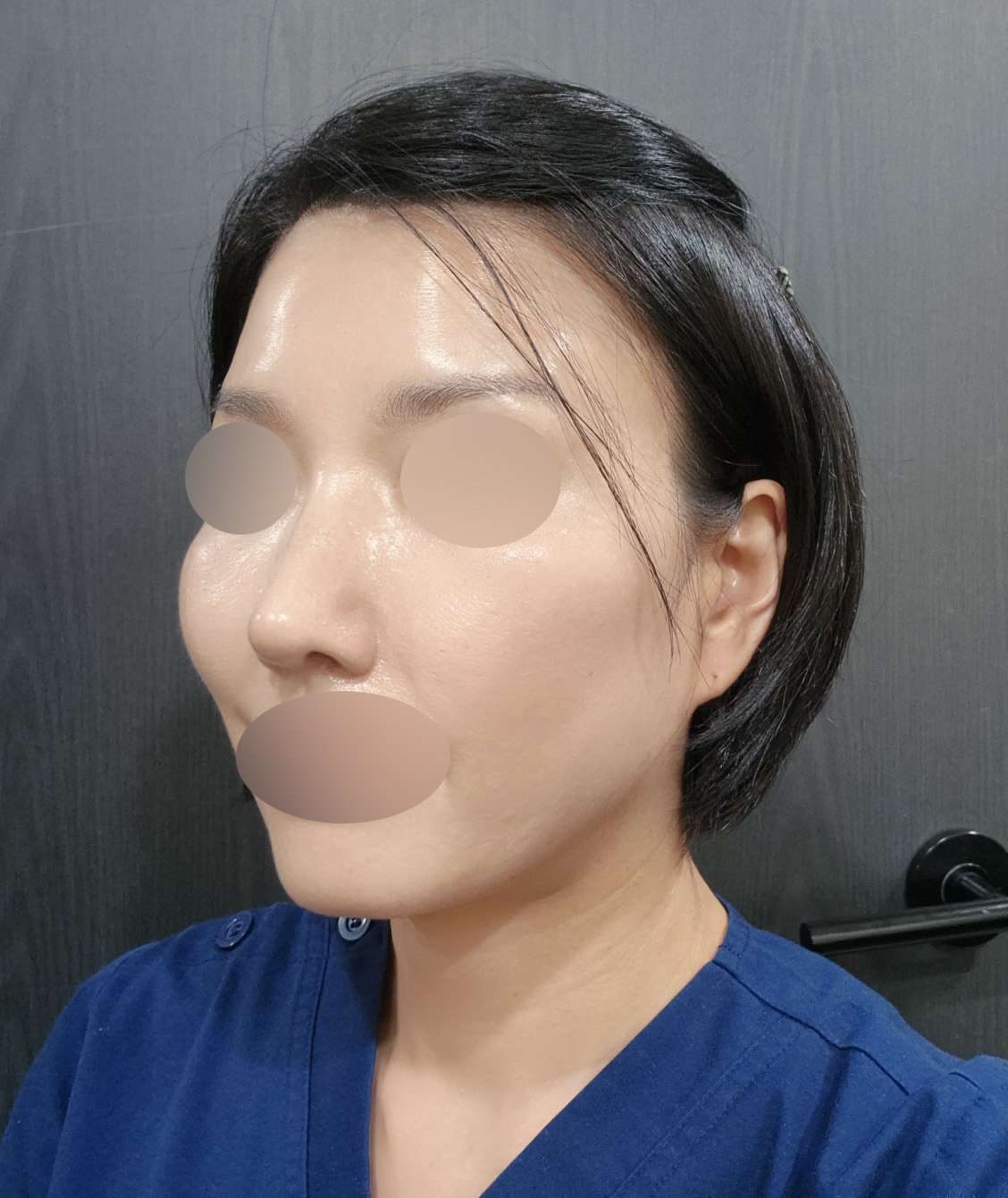 코재수술 2달차, 얄쌍해진 코라인 만족스러워요 :)
