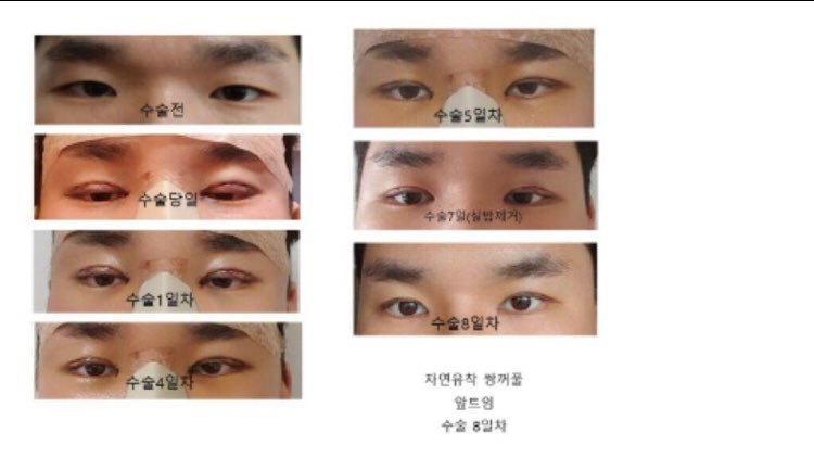 남자 눈+앞트임