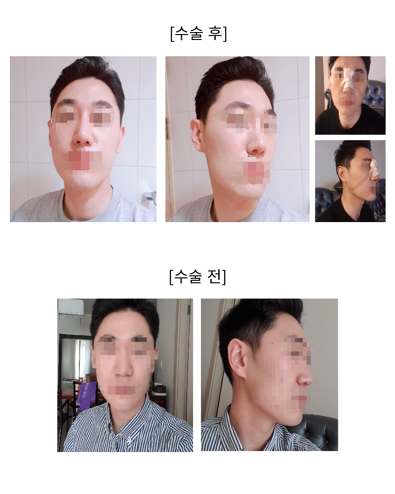 남자 코수술 후기입니다!