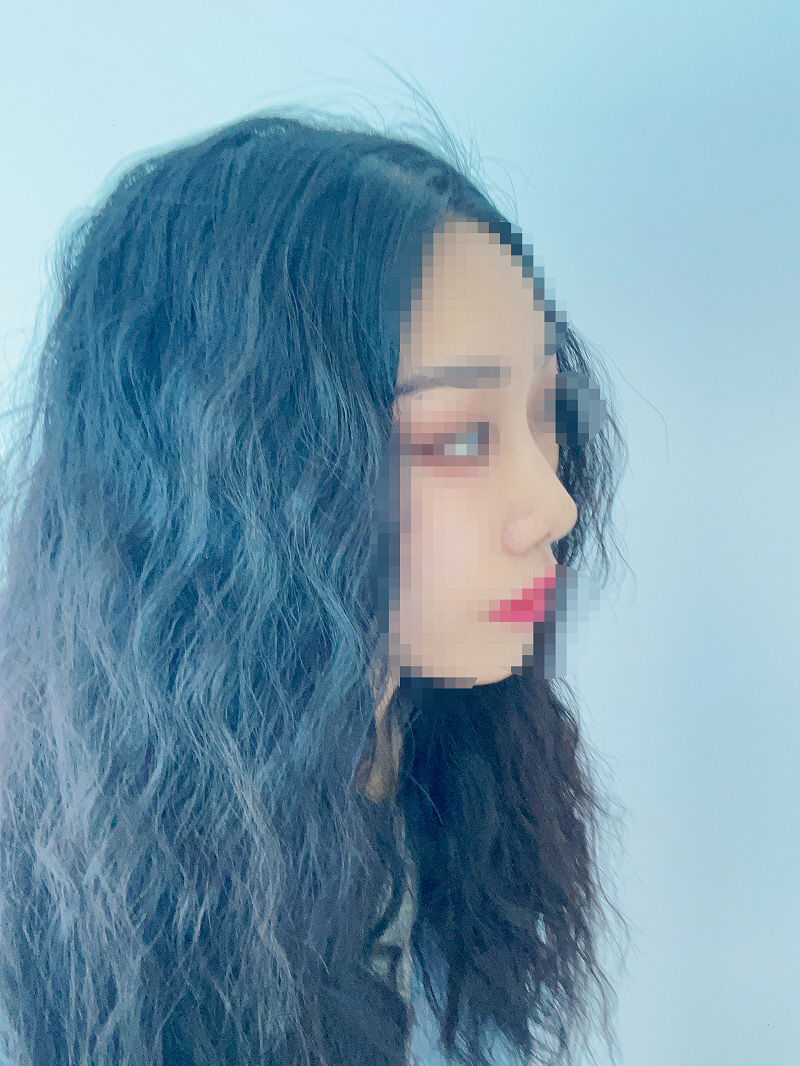 수술 2달차가 되었는데 1주 2주한달때에 겪게되는 불편함들은 서서히 없어지고 표정짓기도 편해지고 있어요.