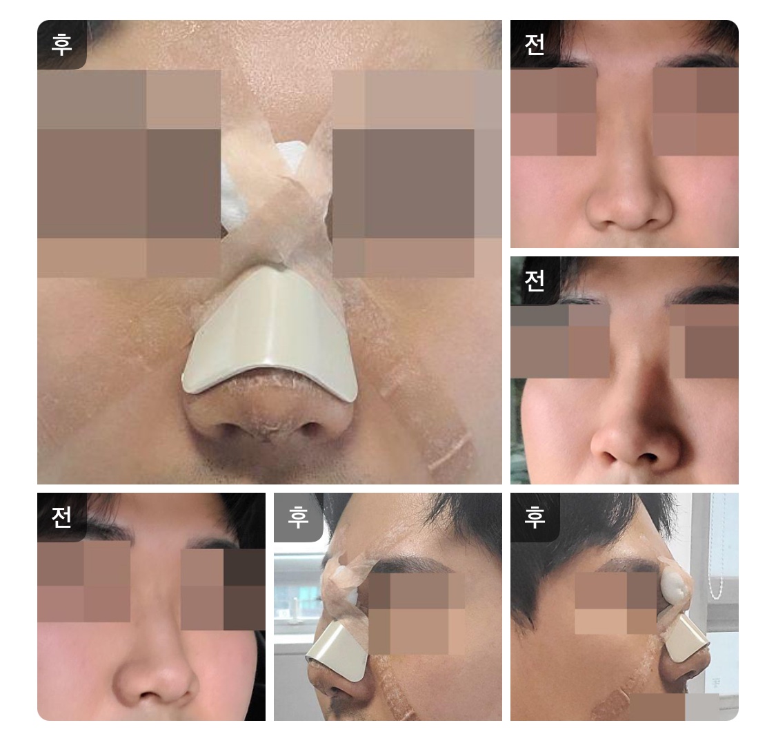 복코에 낮은코 수술했습니다