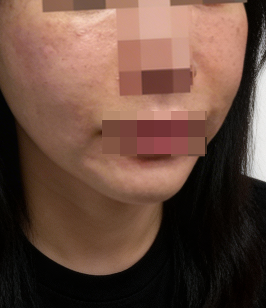 잔주름이랑 건조함 고민으로 리쥬란 받았는데 경과가 벌써 기대돼요