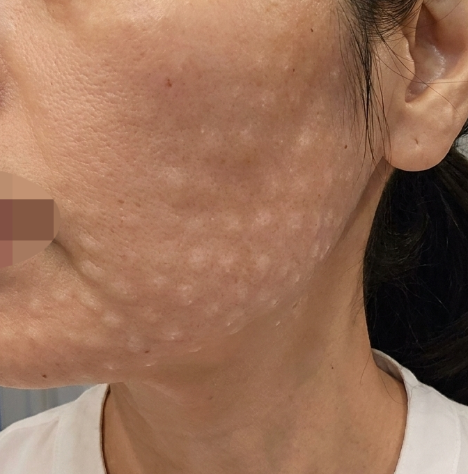 늘어진 피부랑 잔주름 고민, 꼼꼼한 시술로 케어 시작했어요.