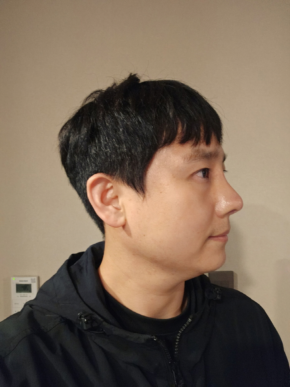 재수술이라 걱정했는데 기대 이상으로 만족스러운 수술이었습니다.