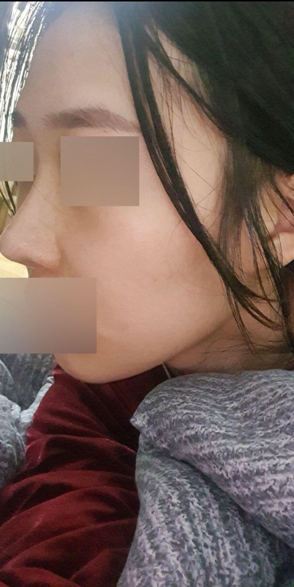 코수술 만족