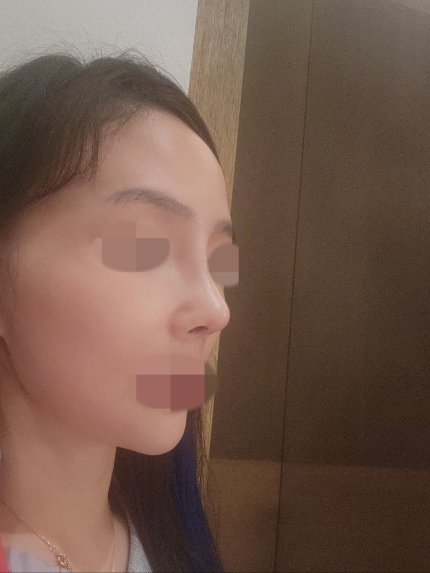 코 하나로 이렇게 인상이 달라질 줄이야 진작에 할걸~~ 부작용없이 이쁘게 해주신 황정일원장님 감사또무한감사드립니다~~