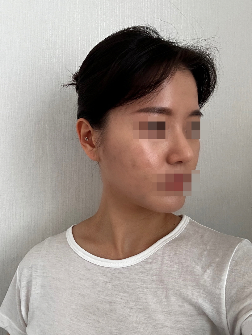 붓기가 빠지니 좀더 자연스러워졌습니다