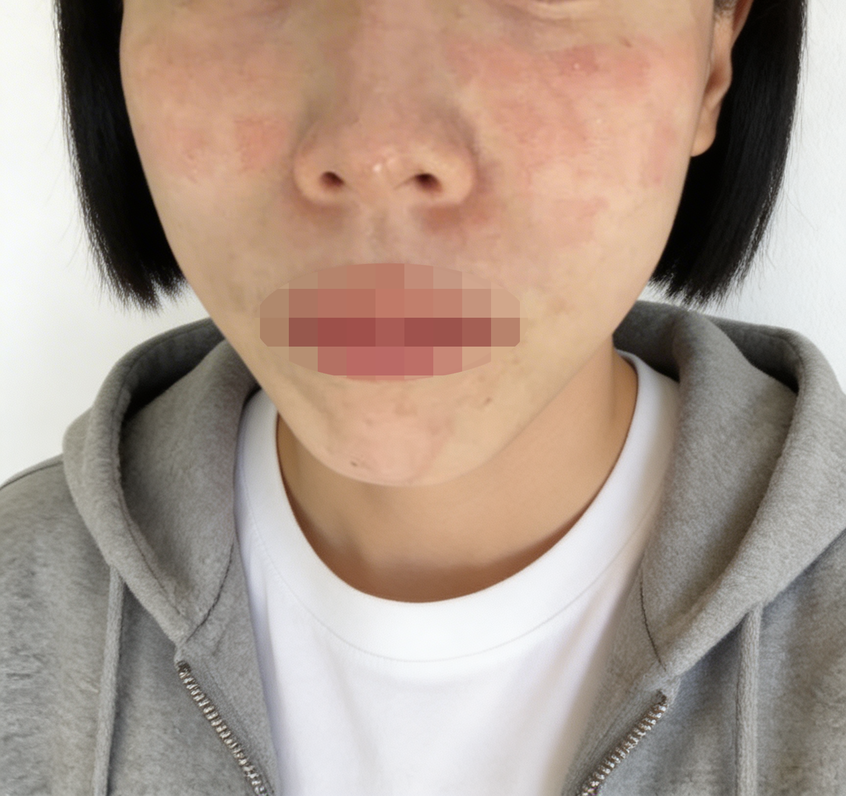 모공이랑 탄력 고민으로 왔는데, 일본어 통역 스태프님으로 원활하게 원하는 거 진행돼서 좋았어요!