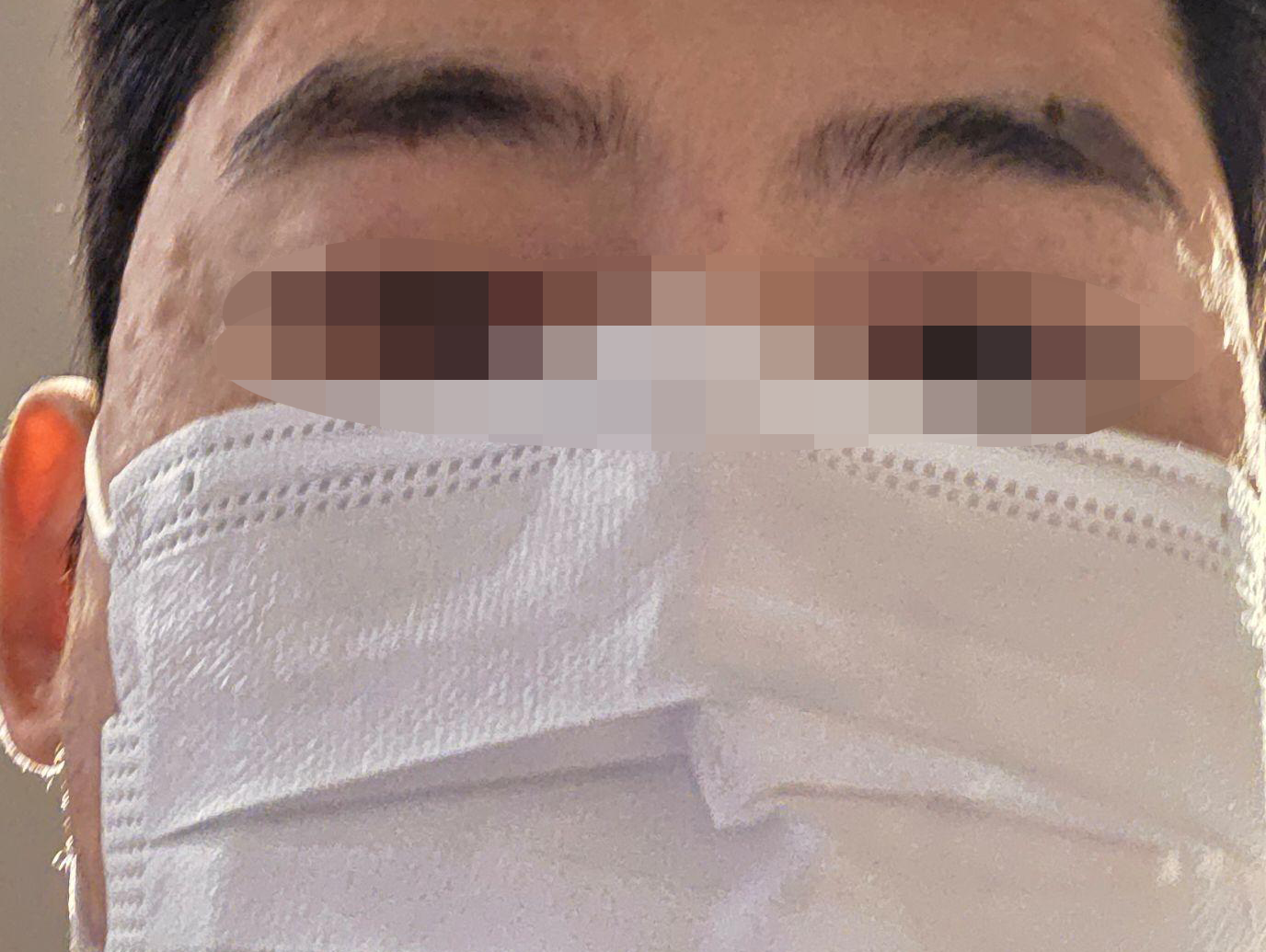여드름 피부 때문에 추천받아서 리쥬란 받아봤습니다.
