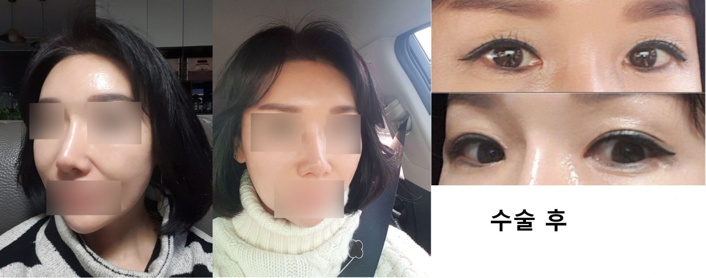 수술후기