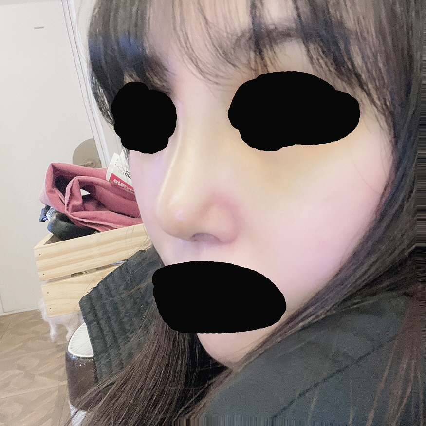 황원장님께 코 보형물, 코끝 (코연골)로 했어요