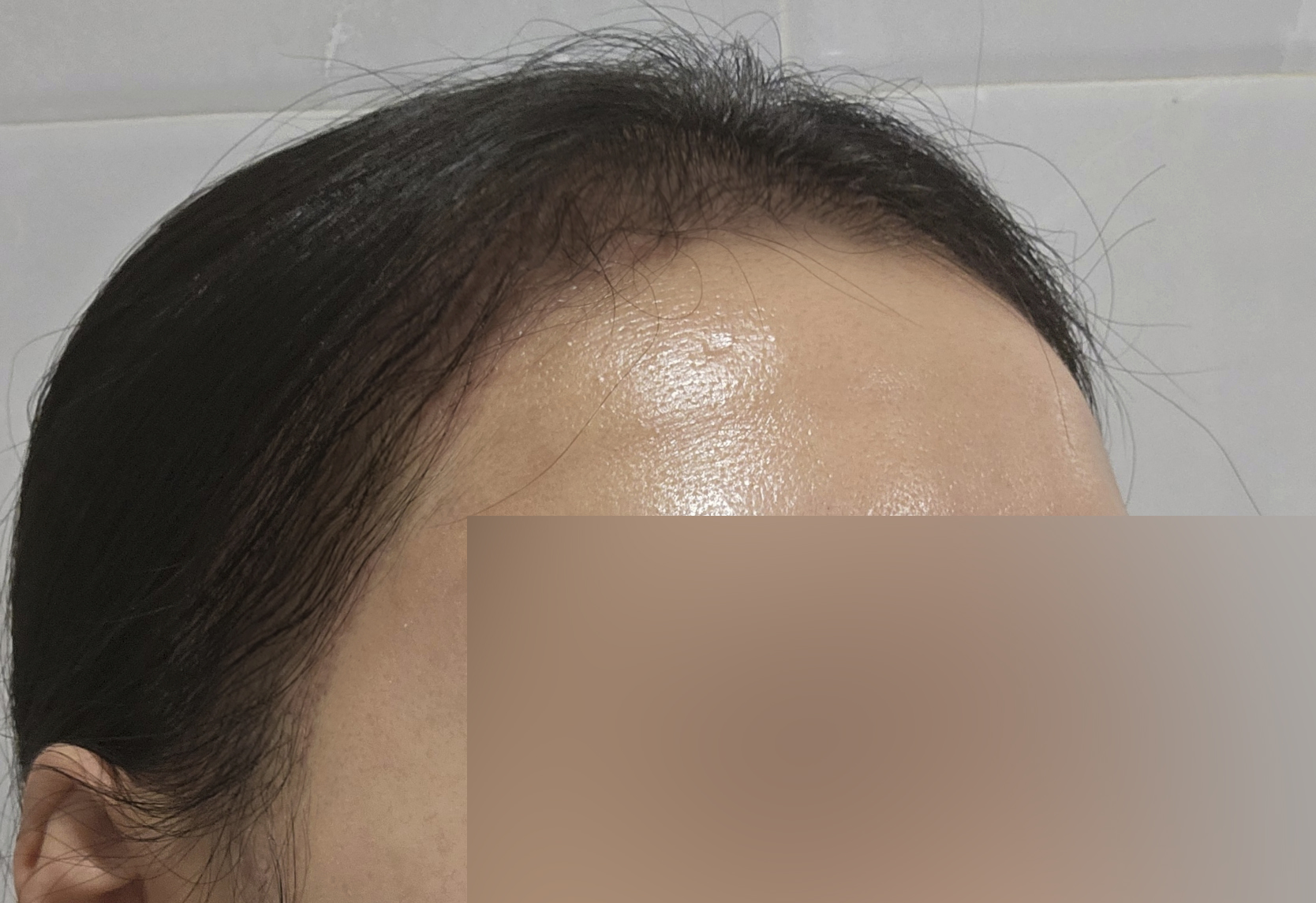 모발이식 2주차 경과 ! 기대 이상으로 자리 잡는 헤어라인
