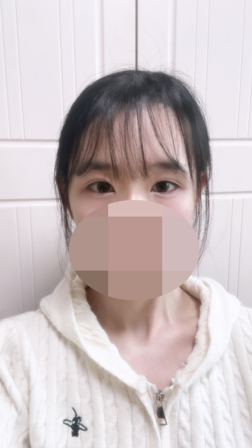 붓기 없이 자연스럽게 자리 잡고 있어서 너무 만족합니다!