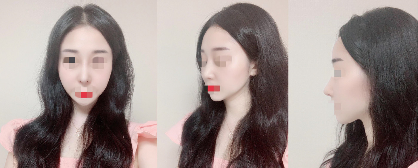 수술 한달차 후기입니당~코 너무 예쁘죵