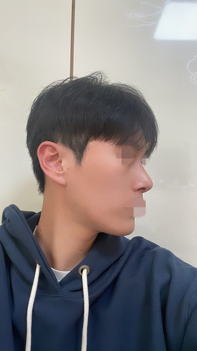 가족들이나 지인들이 코가 예뻐졌다고 많이들이야기하고 부자연스러울까 걱정도 있었는데 생각보다 많이 자연스러워서 만족스러워요