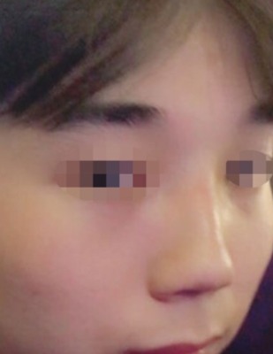 코수술 서울아이 추천합니다!