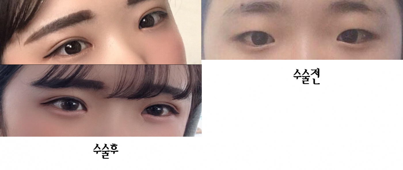 앞트임 눈매교정 쌍수