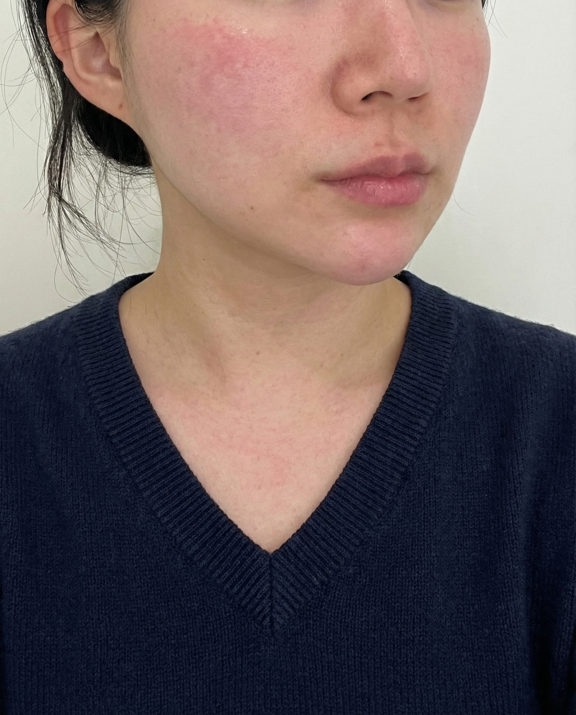 온다리프팅 받았는데 다운타임 없어서 바로 일상생활 가능!