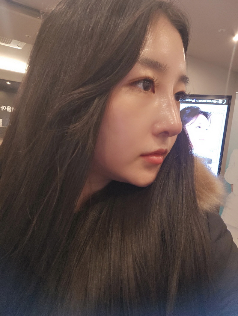 재수술 너무 대만족스러운 성공입니당 ㅎㅎ