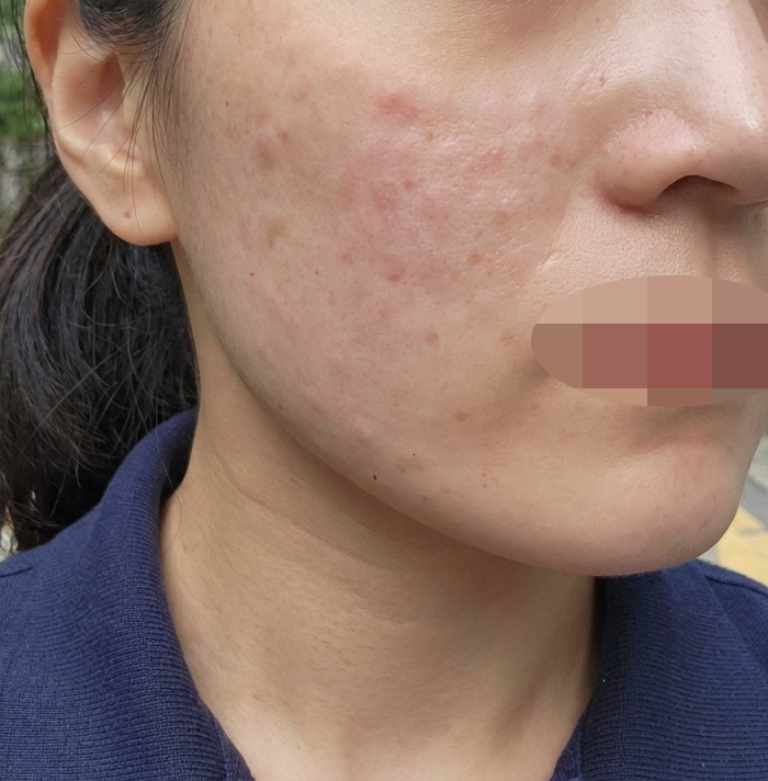첫 리쥬란인데 빠른 응대에 통증 없는 시술까지 만족이에요~