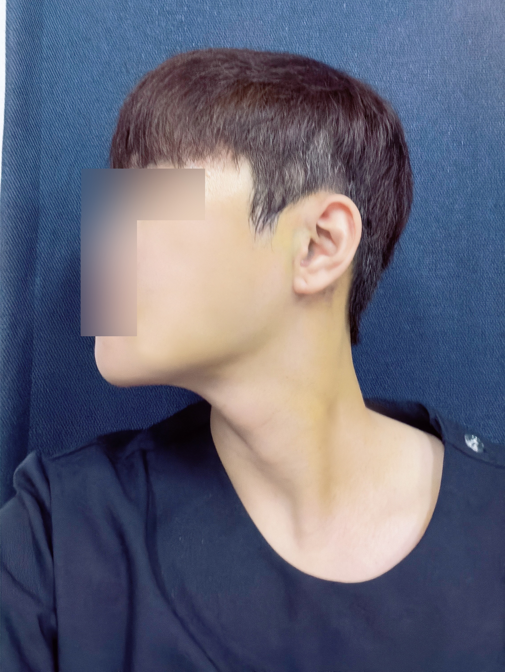 턱끝&광대축소 2주차, 아직 붓기는 있지만 만족 중!