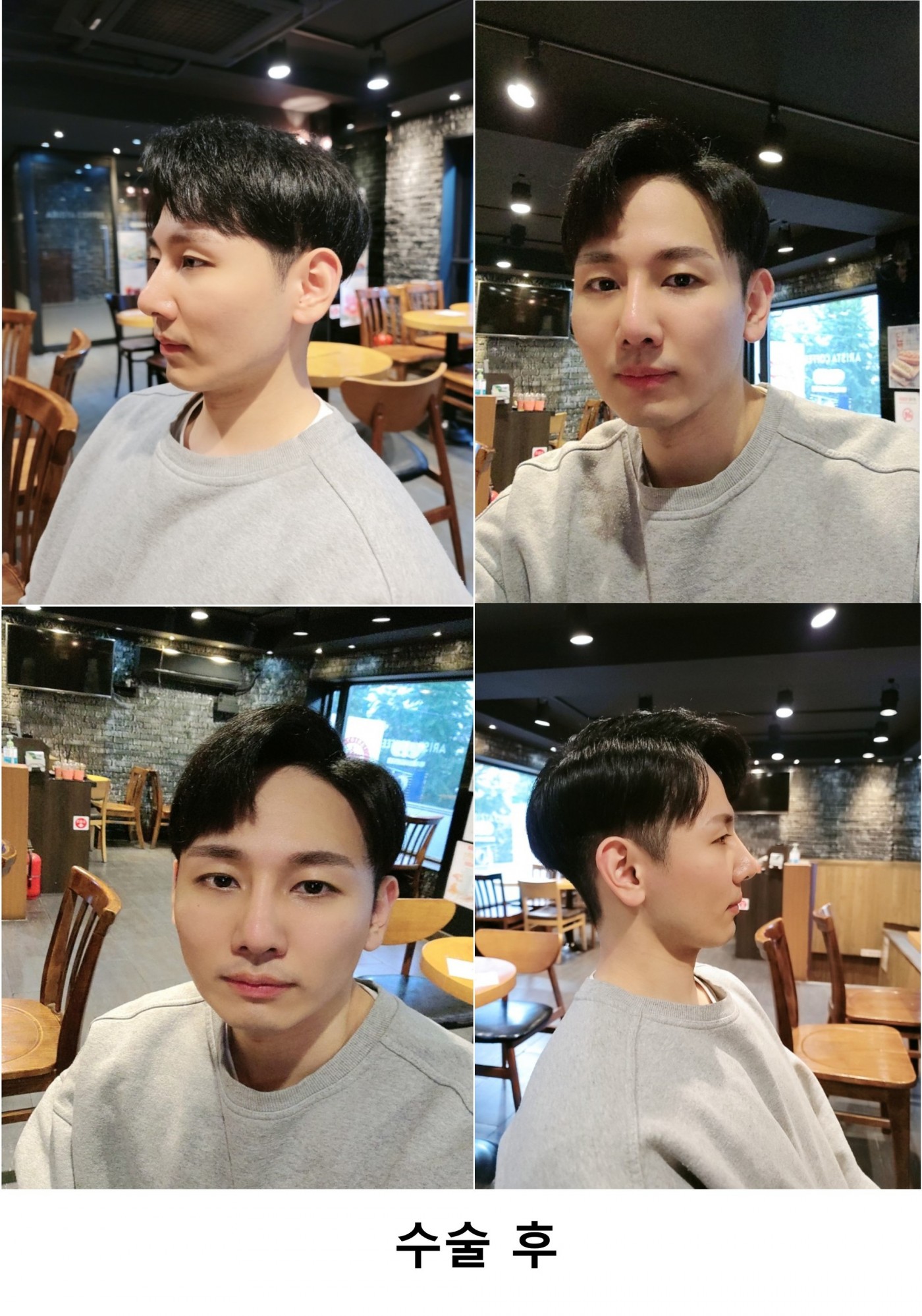 눈코 성형후기