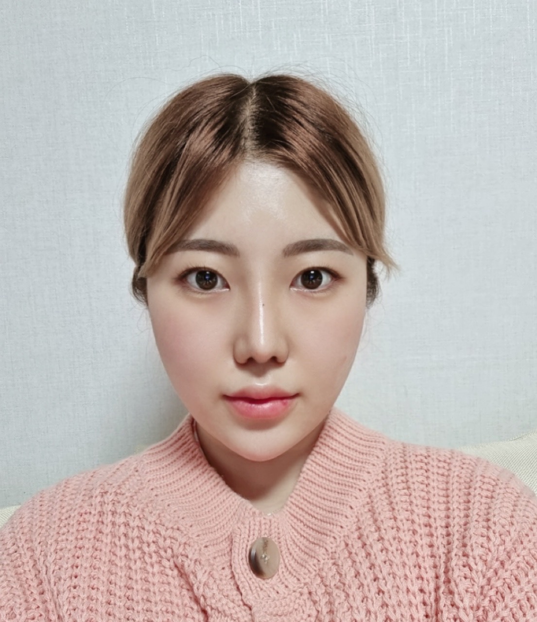 복코, 휜코 수술 후기