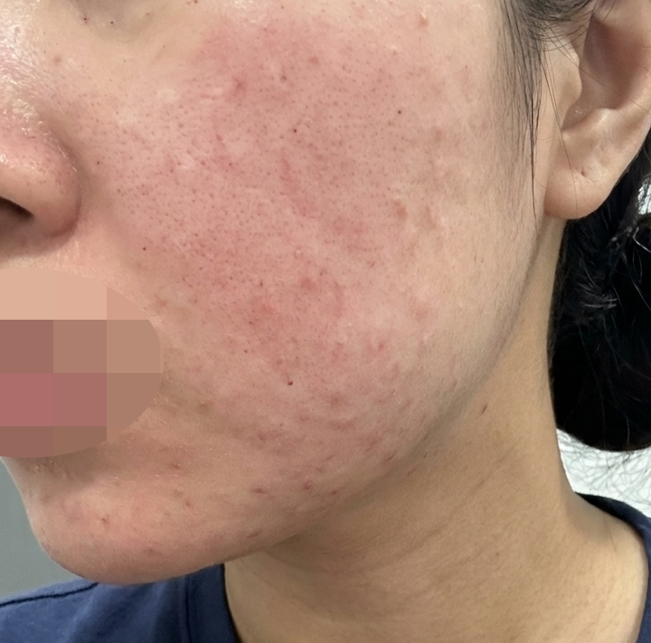 수면 덕분에 통증 없이 받은 리쥬란 + 슈링크, 진짜 추천이에요~