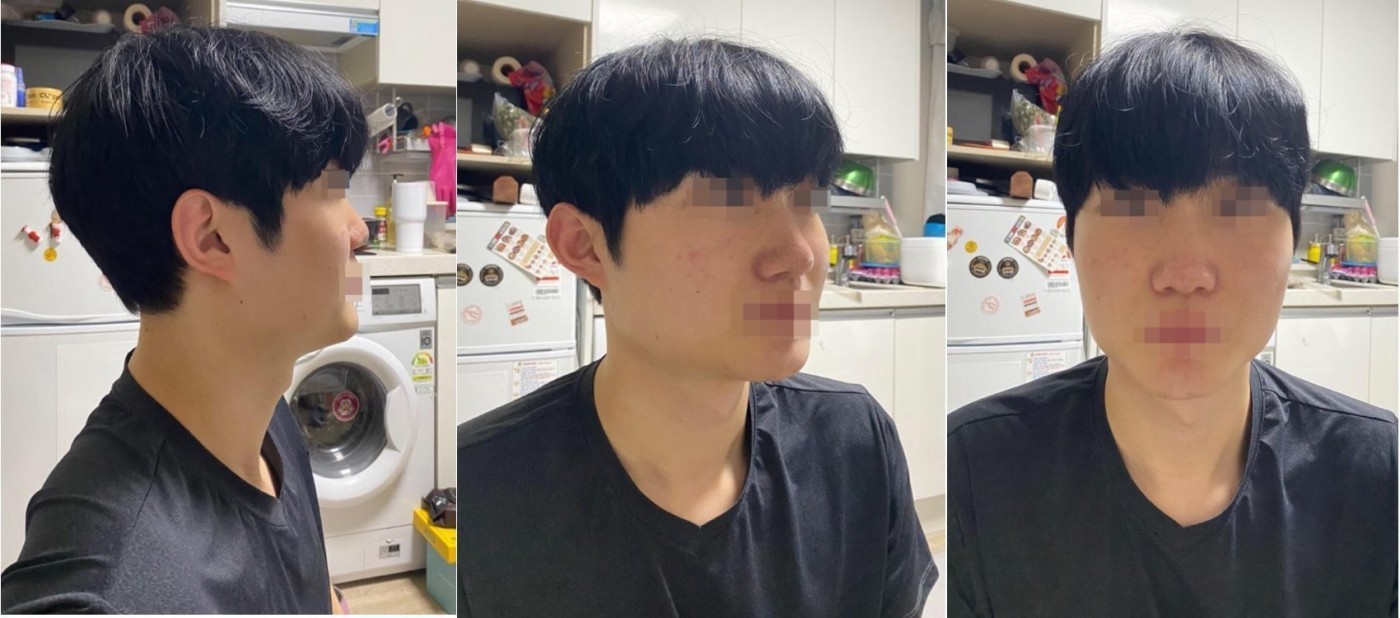 복코 수술 1주차