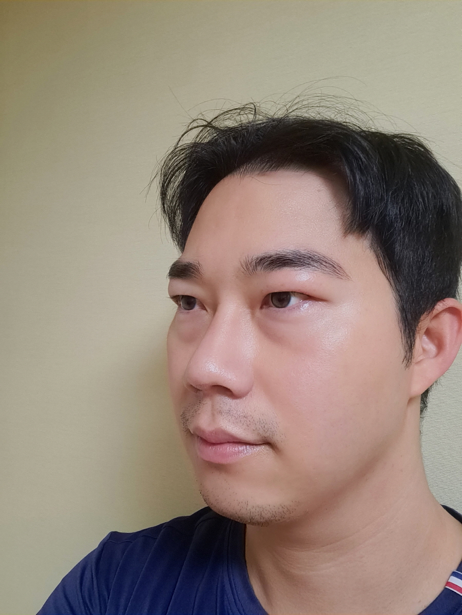 붓기빠지면서 자리가 예쁘게 잘 잡혔어요