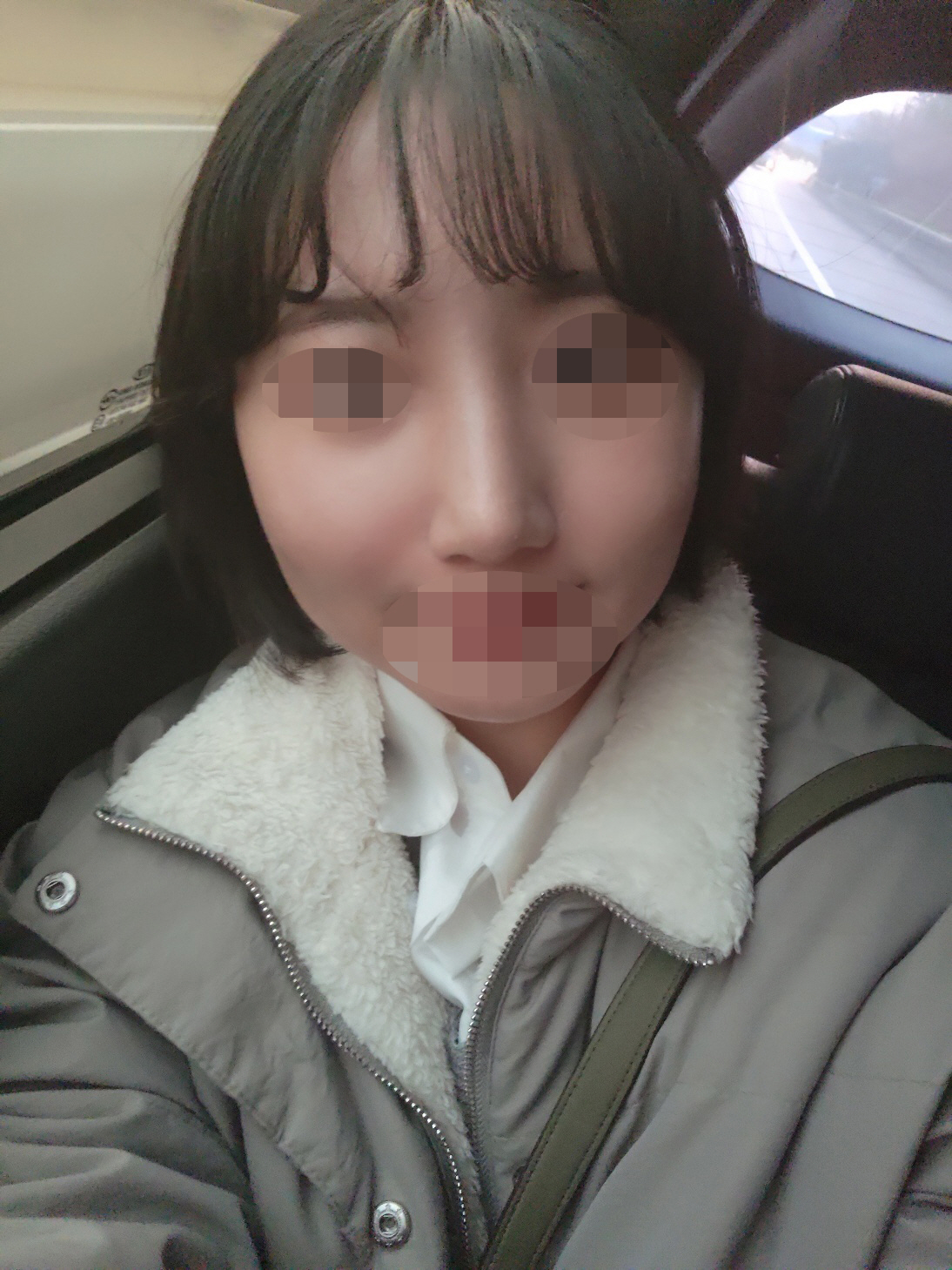 휜코 수술을 받았습니다.!