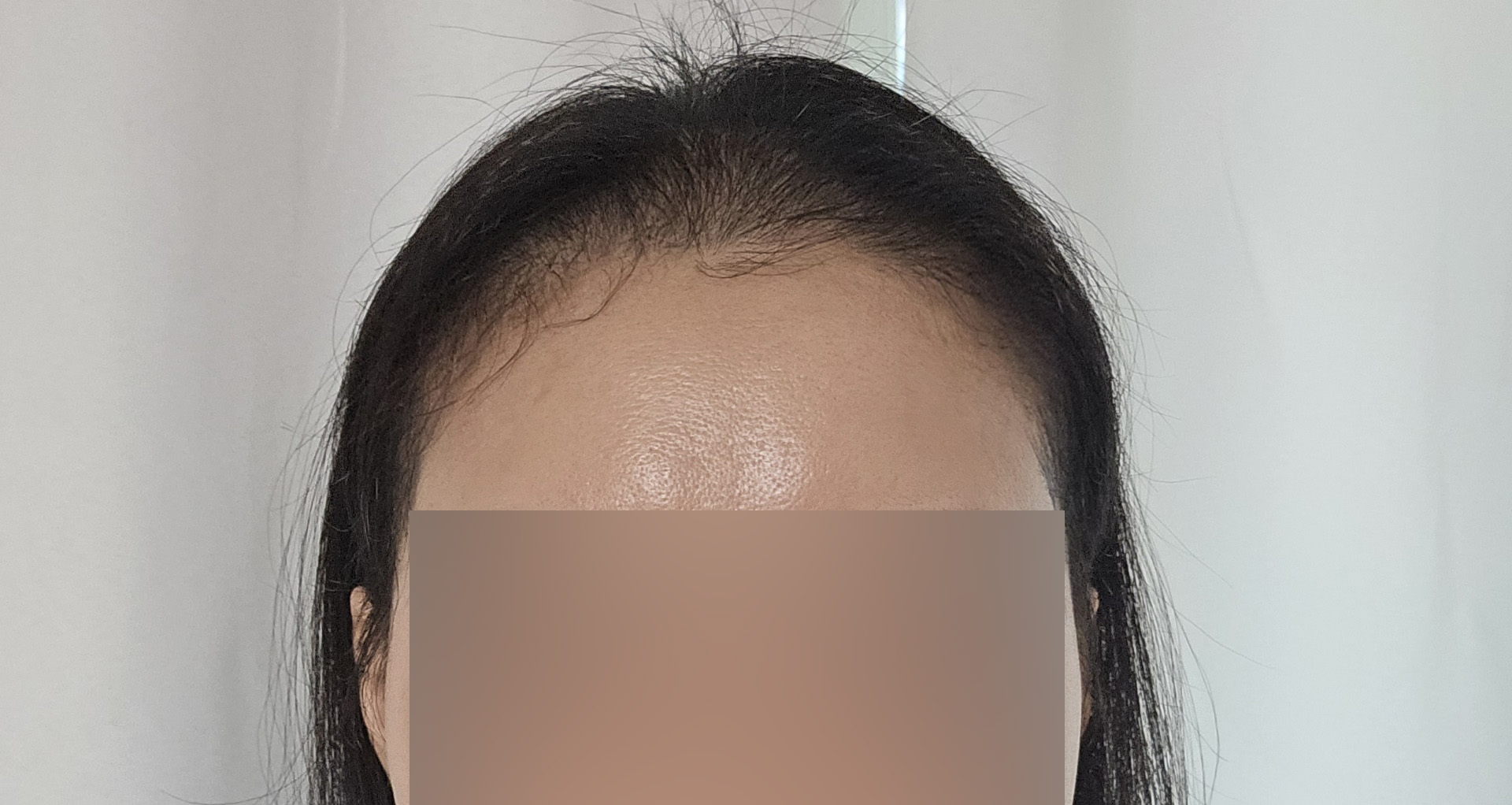 비절개 삭발 모발이식 3개월차 후기, 자연스럽게 자라나는 머리카락