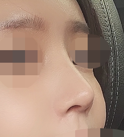 이제 붓기도 많이 가라앉아 만족스럽습니다!!