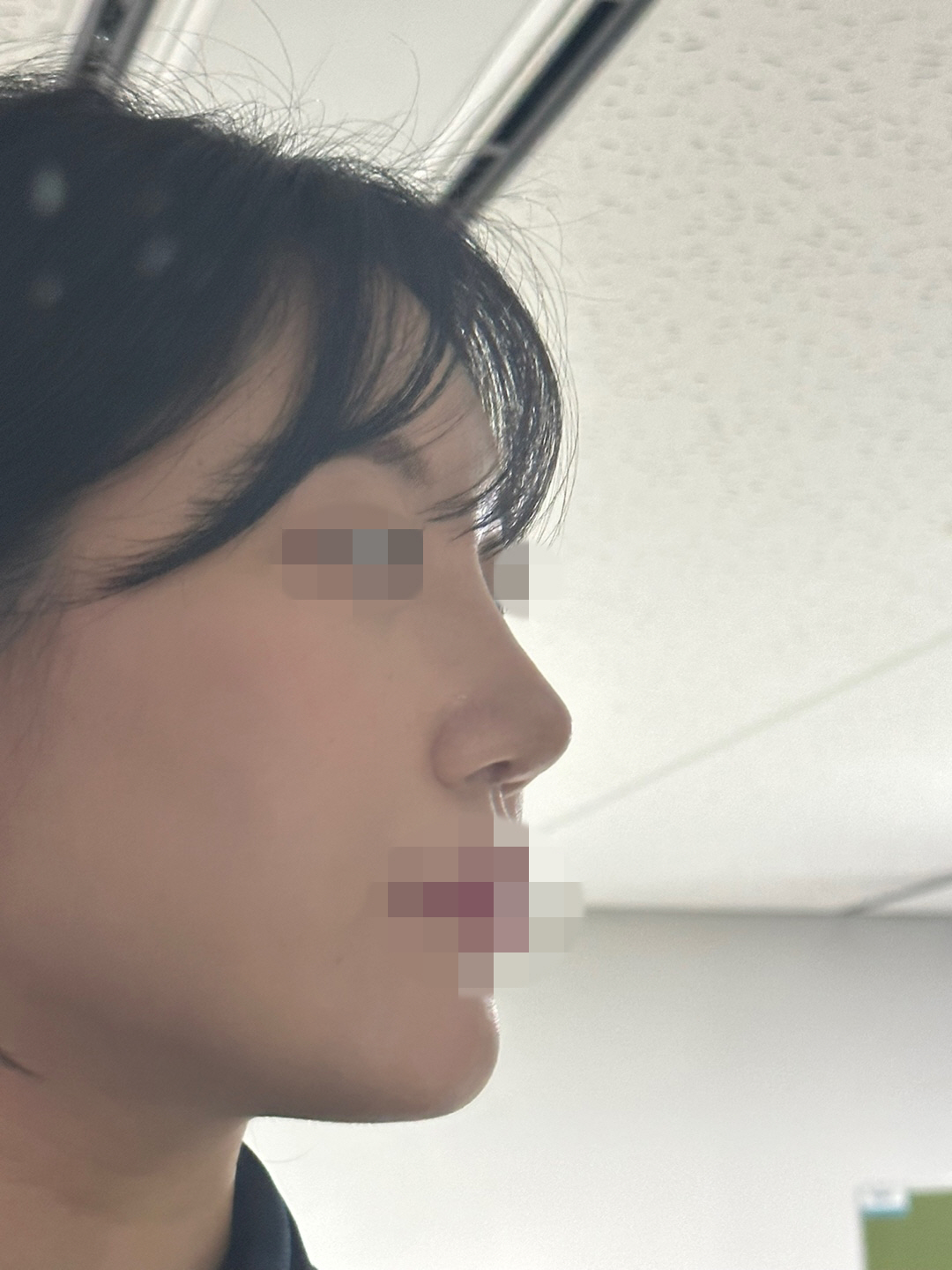 코수술한지 2주차 된 후기입니다.