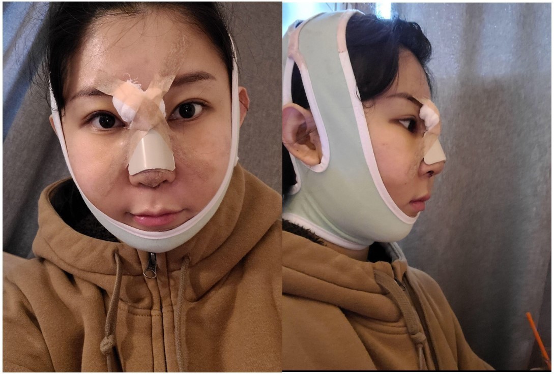 코수술 얼지흡 리프팅 했어요