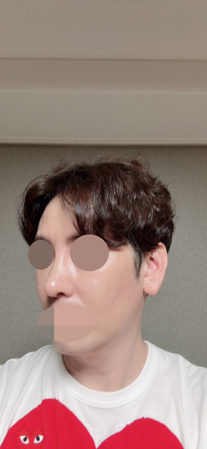 수술후 너무나 만족하고 있어요~