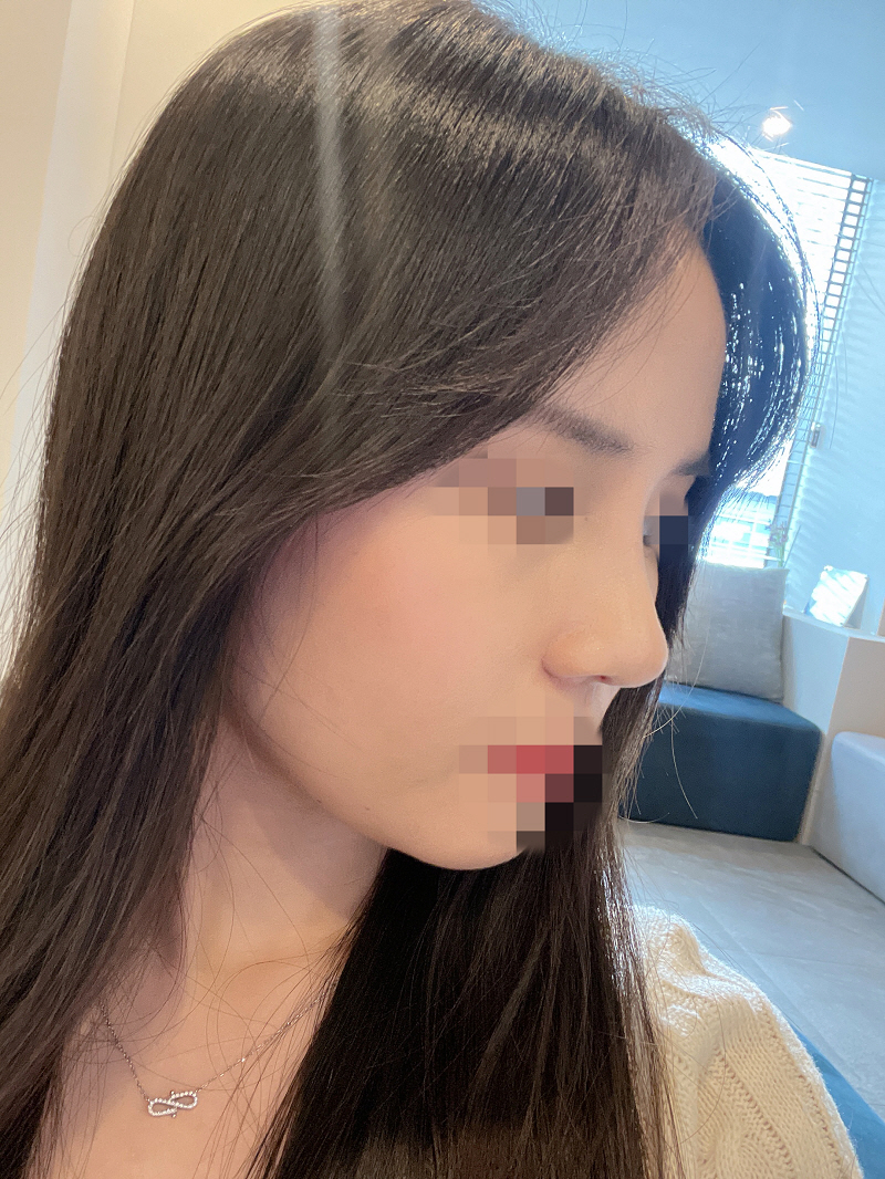 코 알아보고 5곳 발품 팔던 중에 서울아이 황원장님 선택했어용 ᄒᄒ