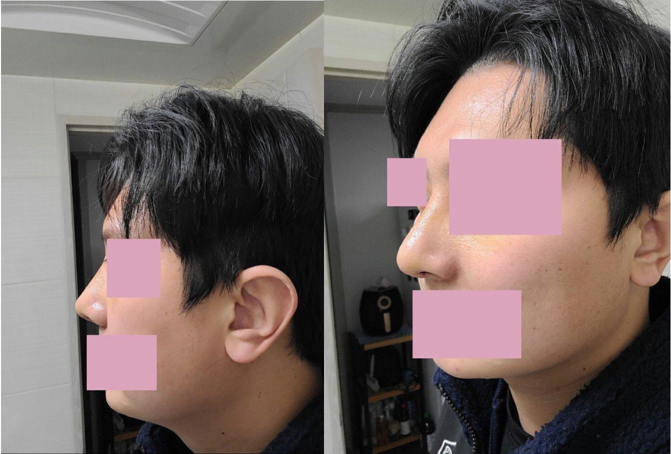 코 수술후기요